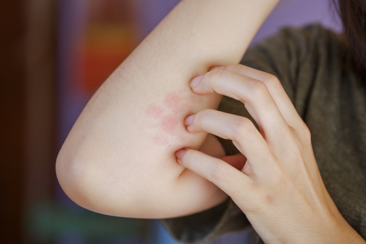 Don’t Scratch the Itch: How To Identify and Treat Bug Bites